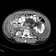 Anaplastic lymphoma in peritoneal cavity, retroperitoneal and mesenterial lymphadenopathy: CT - Computed tomography